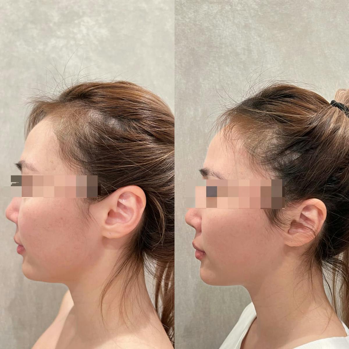 Sylfirm X Microneedling Before & After Gallery - Patient 133227651 - Image 2