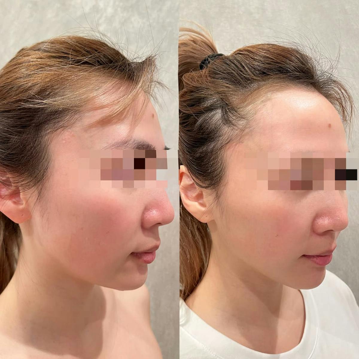Sylfirm X Microneedling Before & After Gallery - Patient 133227651 - Image 1