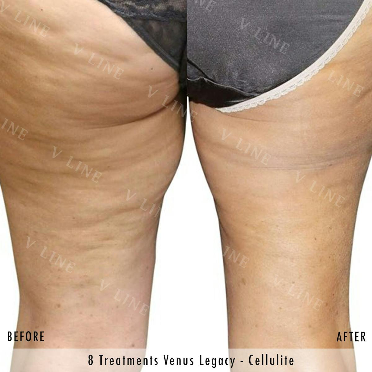 Venus Legacy Before & After Gallery - Patient 133236361 - Image 1