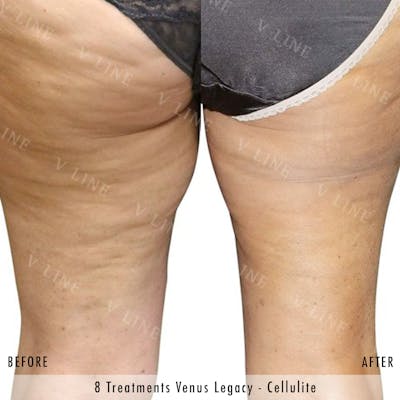 Venus Legacy Before & After Gallery - Patient 133236361 - Image 1