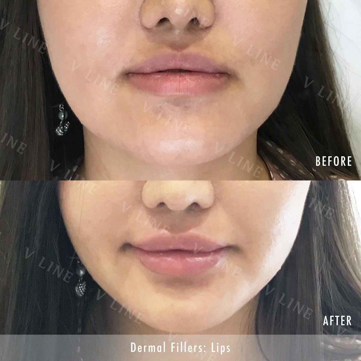 Dermal Fillers Before & After Gallery - Patient 133227333 - Image 1