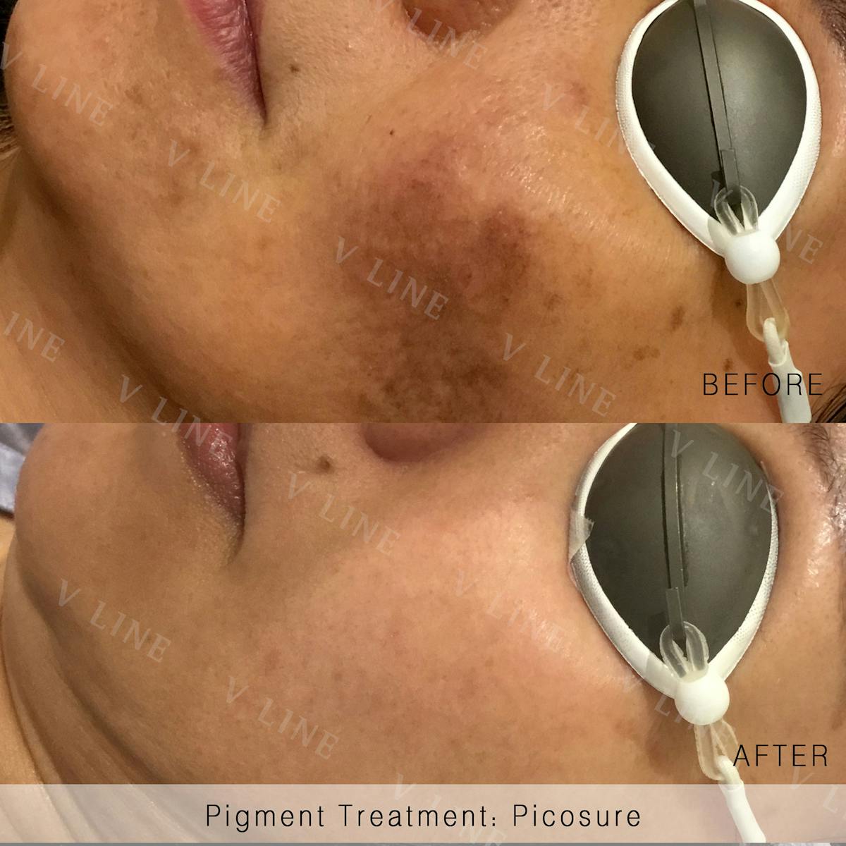 Picosure Before & After Gallery - Patient 133227432 - Image 1
