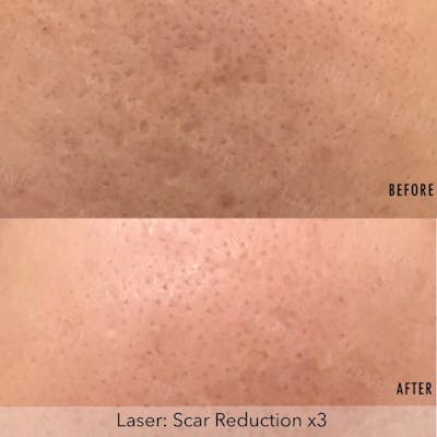 Scar Treatment Before & After Gallery - Patient 133236016 - Image 1