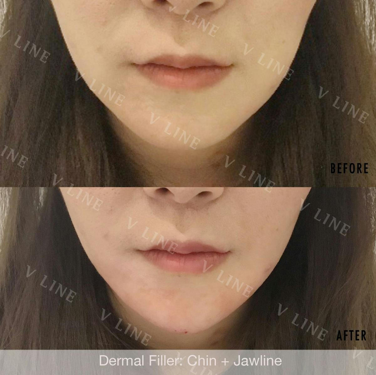 Dermal Fillers Before & After Gallery - Patient 133227336 - Image 1