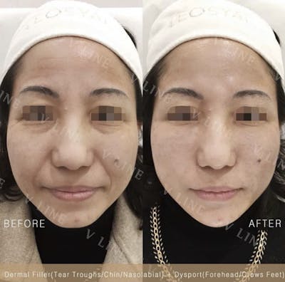 Dermal Fillers Before & After Gallery - Patient 133227323 - Image 1
