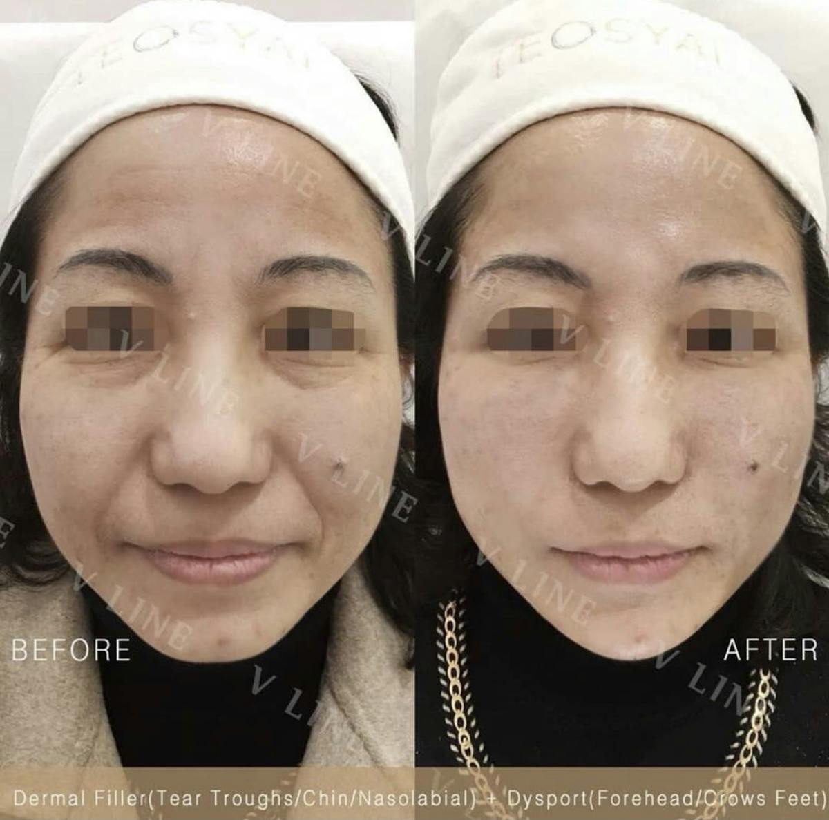 Dermal Fillers Before & After Gallery - Patient 133227323 - Image 1