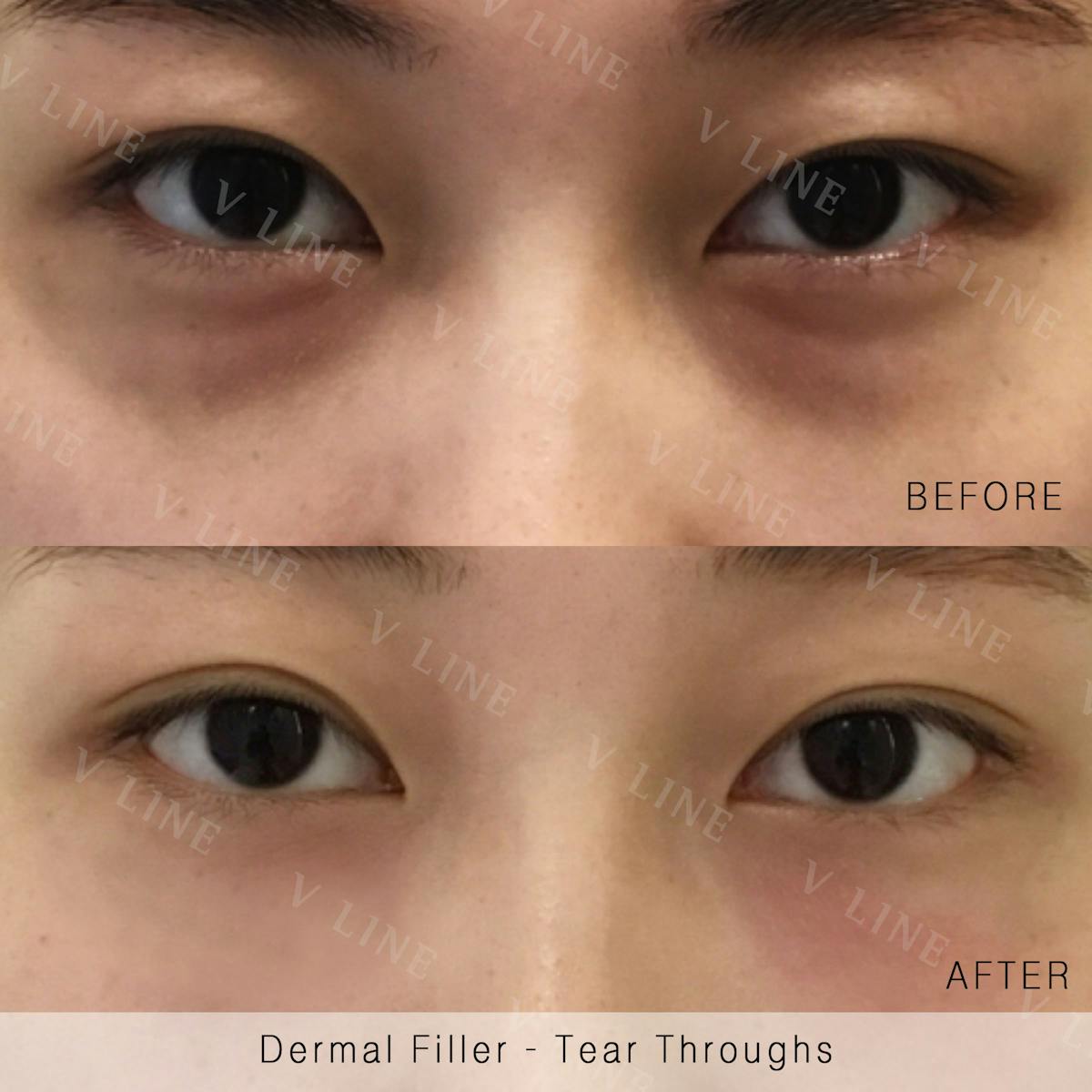 Dermal Fillers Before & After Gallery - Patient 133227324 - Image 1