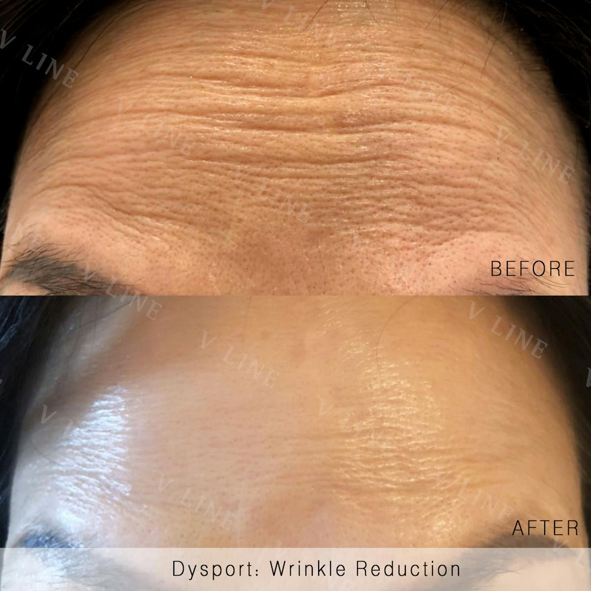 Wrinkle Relaxers Before & After Gallery - Patient 133235224 - Image 1