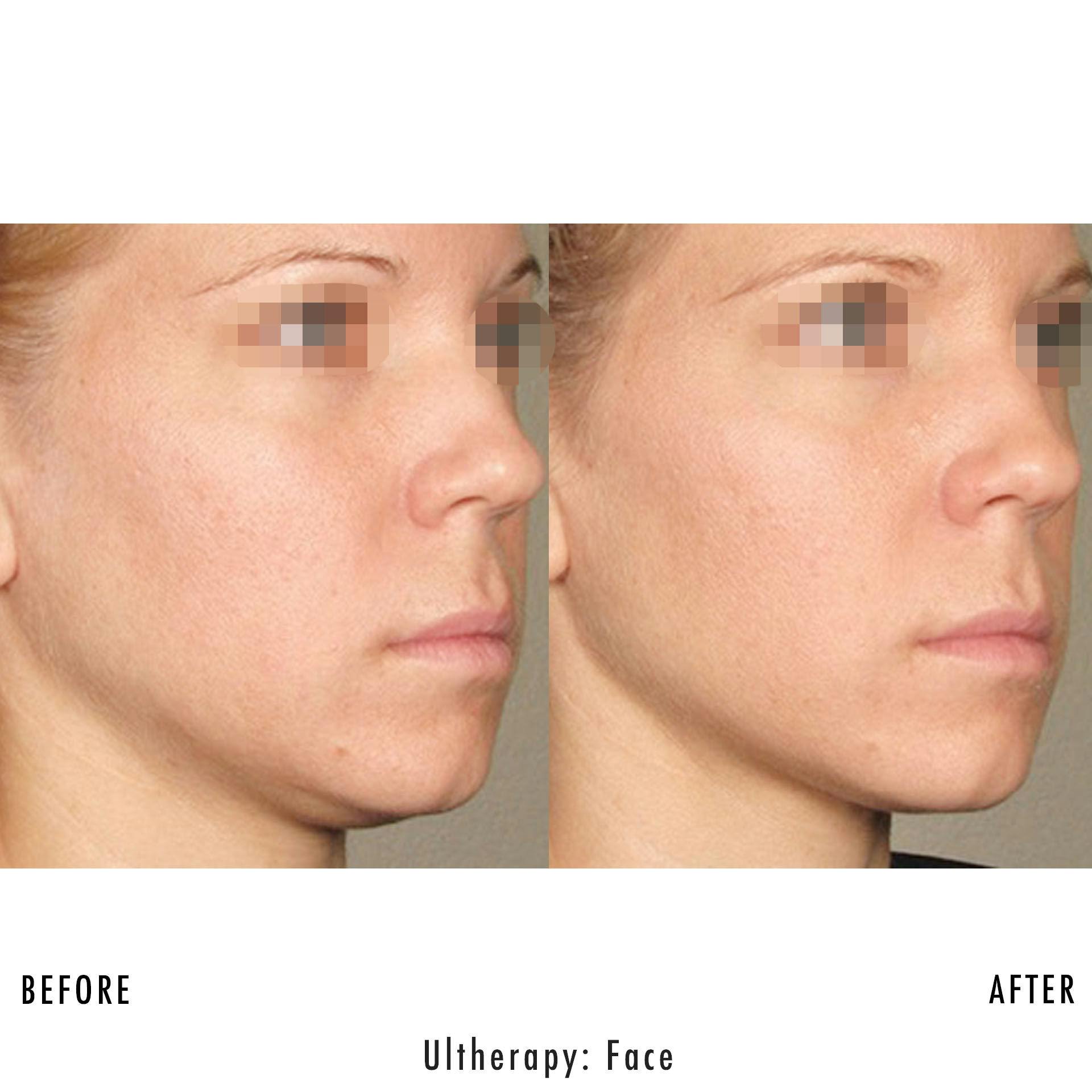 Patient 133227411 Ultherapy Before & After Photos V Line Cosmetic Center