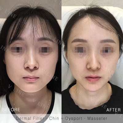 Dermal Fillers Before & After Gallery - Patient 133227322 - Image 1