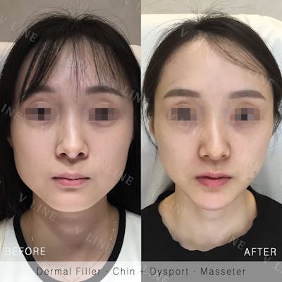 Dermal Fillers Before & After Gallery - Patient 133227322 - Image 1
