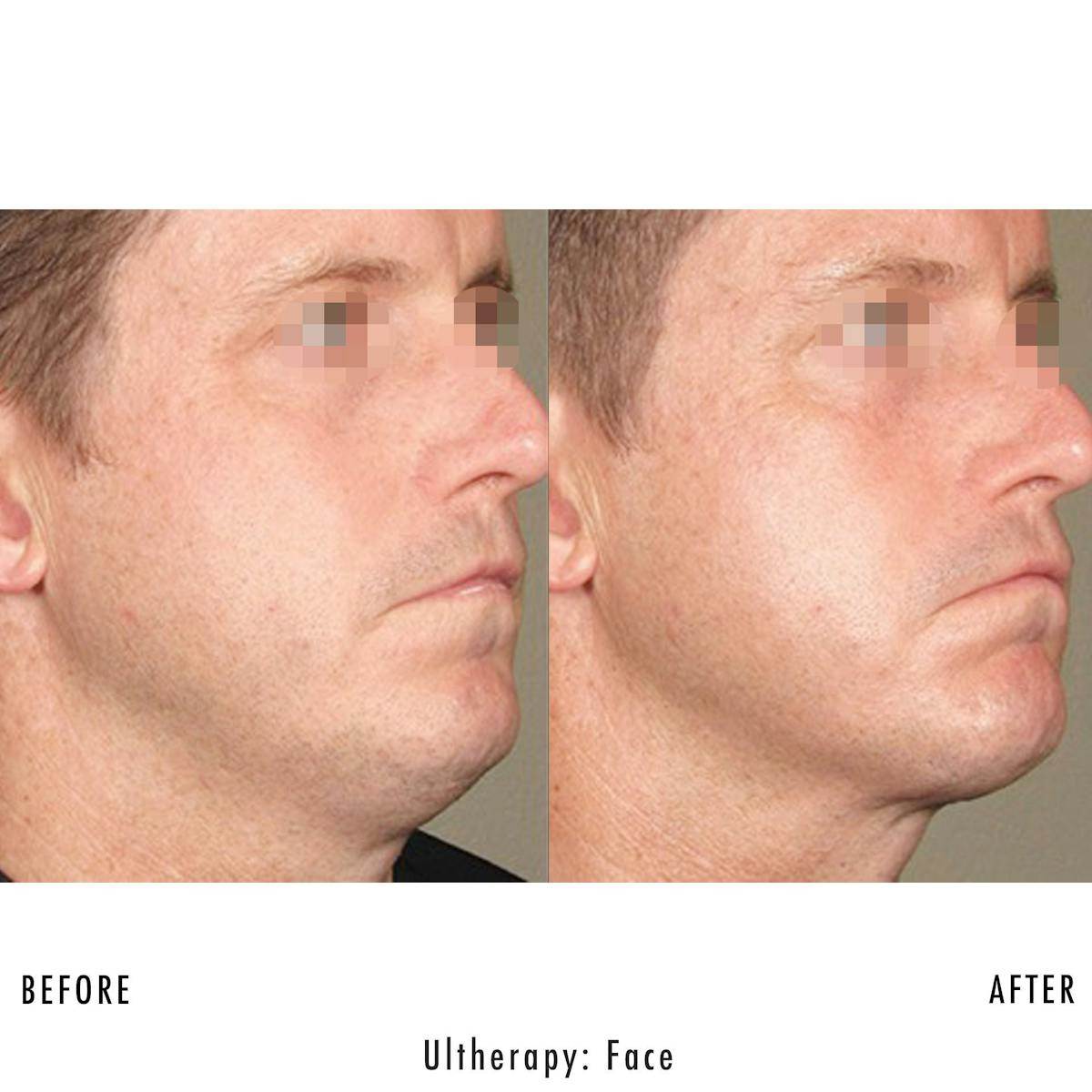 Ultherapy Before & After Gallery - Patient 133227412 - Image 1