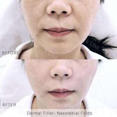 Dermal Fillers Before & After Gallery - Patient 133227328 - Image 1