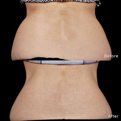 CoolSculpting Before & After Gallery - Patient 133227392 - Image 1