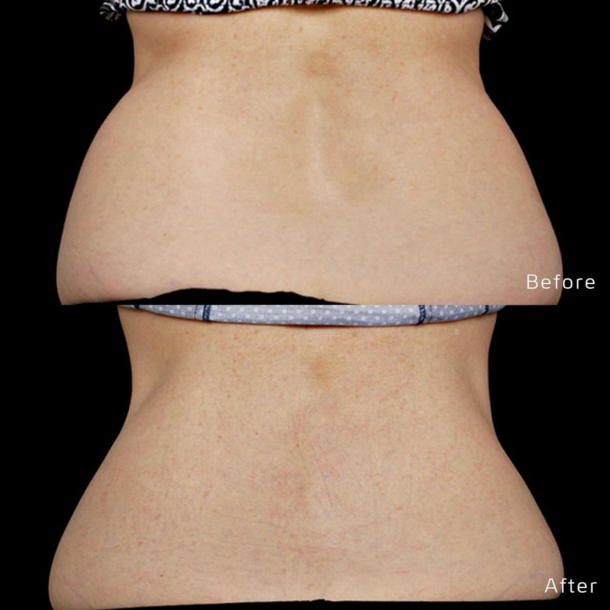 CoolSculpting Before & After Gallery - Patient 133227392 - Image 1