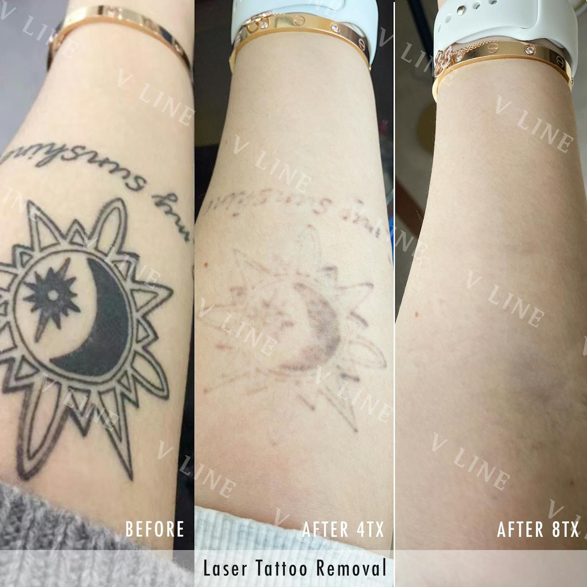 Laser Tattoo Removal Before & After Gallery - Patient 133236024 - Image 1
