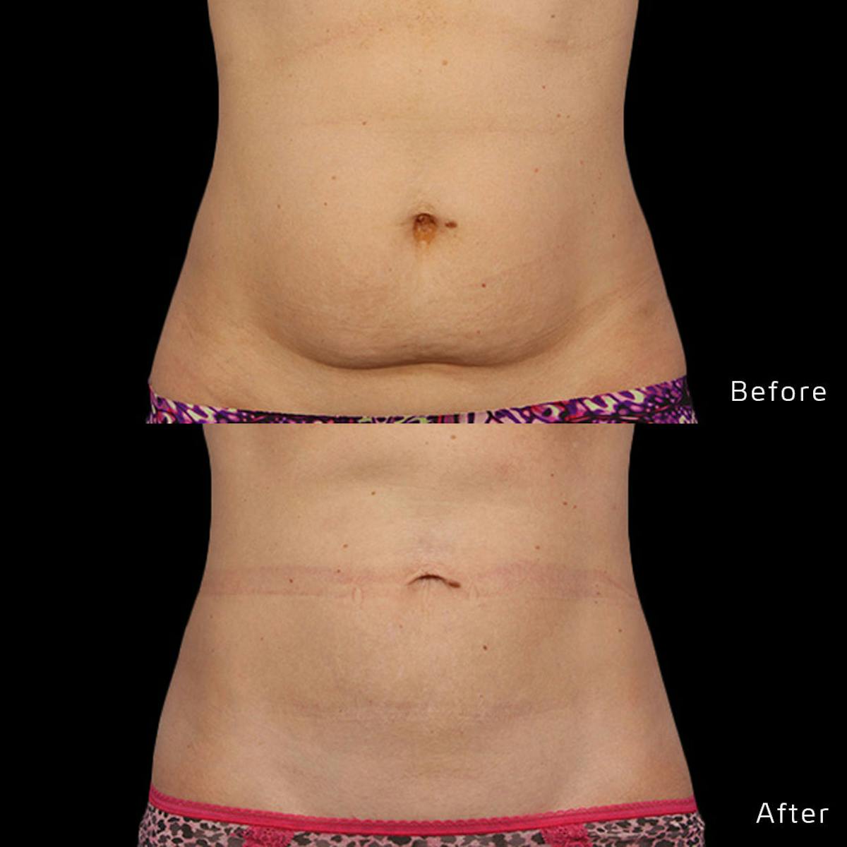 CoolSculpting Before & After Gallery - Patient 133227393 - Image 1