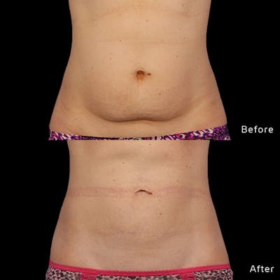 CoolSculpting Before & After Gallery - Patient 133227393 - Image 1