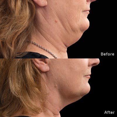 CoolSculpting Before & After Gallery - Patient 133227395 - Image 1