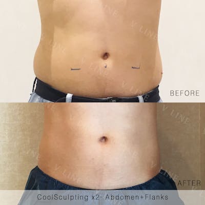 CoolSculpting Before & After Gallery - Patient 133227390 - Image 1