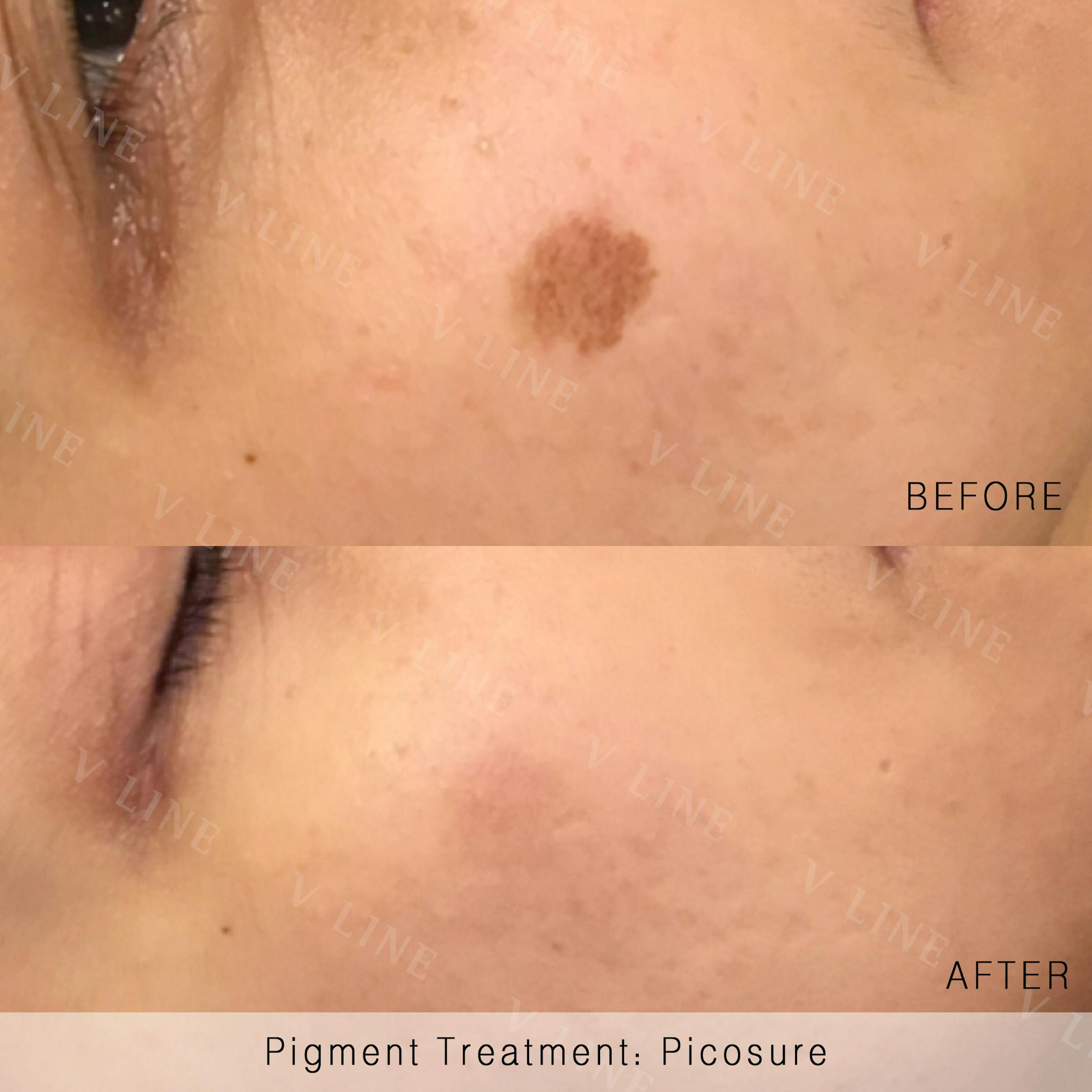 Patient 133227425 Picosure Before & After Photos V Line Cosmetic Center