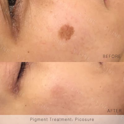 Picosure Before & After Gallery - Patient 133227425 - Image 1