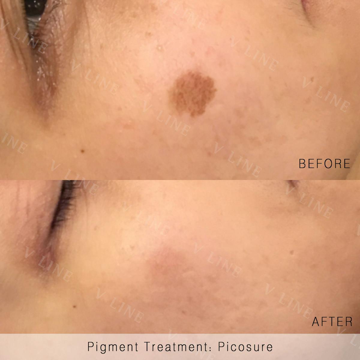 Picosure Before & After Gallery - Patient 133227425 - Image 1