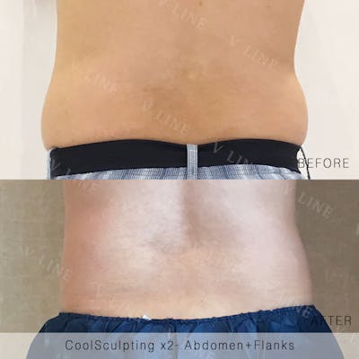 CoolSculpting Before & After Gallery - Patient 133227389 - Image 1
