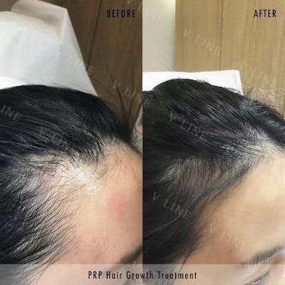Hair Treatment Before & After Gallery - Patient 133265042 - Image 1