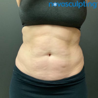 Abdomen Before & After Gallery - Patient 133024786 - Image 1
