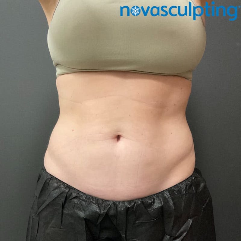 Abdomen