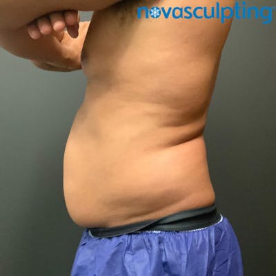 Abdomen Before & After Gallery - Patient 133024787 - Image 1