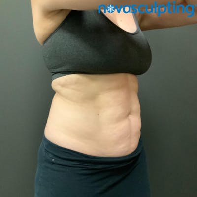 Abdomen Before & After Gallery - Patient 133024788 - Image 1