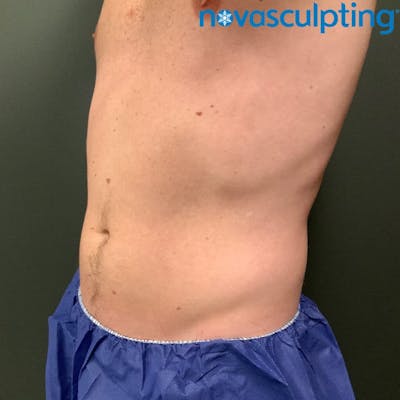 Abdomen Before & After Gallery - Patient 133024790 - Image 2