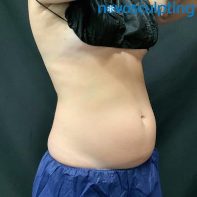 Abdomen Before & After Gallery - Patient 133024791 - Image 1