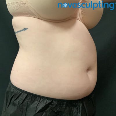 Abdomen Before & After Gallery - Patient 133024797 - Image 1