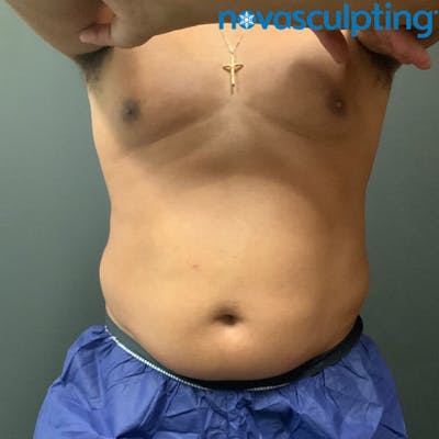 Abdomen Before & After Gallery - Patient 133024799 - Image 1
