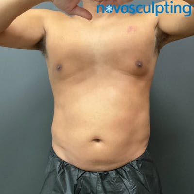 Abdomen Before & After Gallery - Patient 133024799 - Image 2
