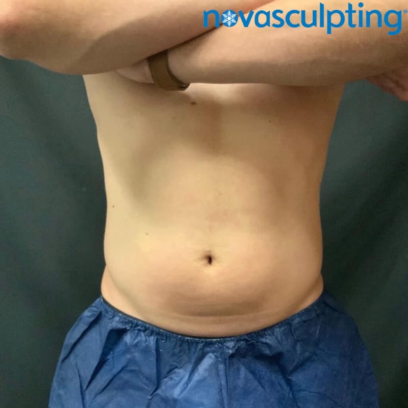 Abdomen Before & After Gallery - Patient 133024804 - Image 1
