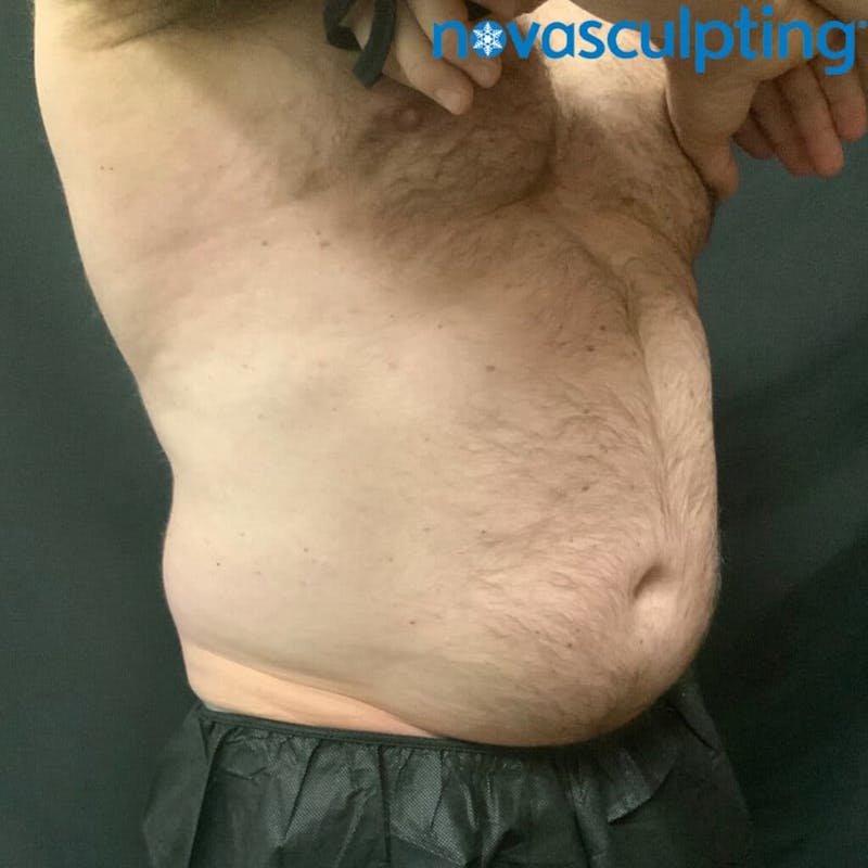 Abdomen Before & After Gallery - Patient 133024805 - Image 1