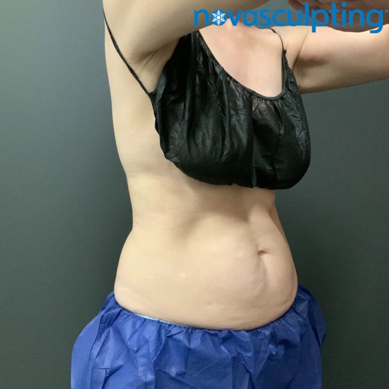 Abdomen Before & After Gallery - Patient 133024807 - Image 1