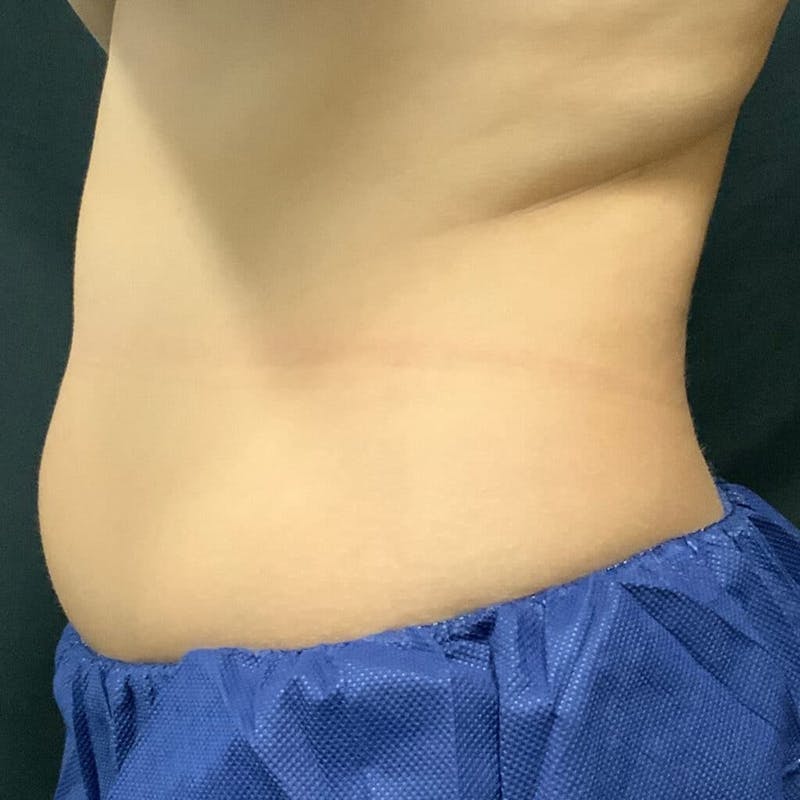 Abdomen Before & After Gallery - Patient 133024809 - Image 1
