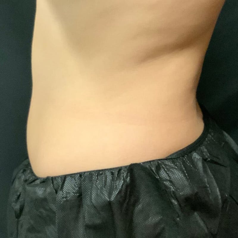 Abdomen Before & After Gallery - Patient 133024809 - Image 2