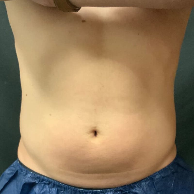 Abdomen Before & After Gallery - Patient 133024810 - Image 1