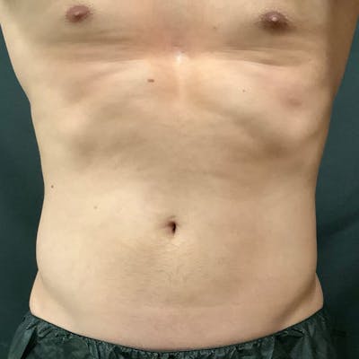 Abdomen Before & After Gallery - Patient 133024810 - Image 2