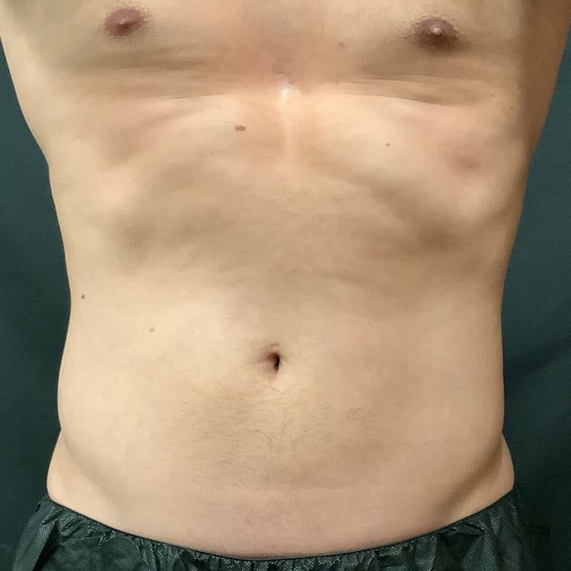 Abdomen Before & After Gallery - Patient 133024810 - Image 2