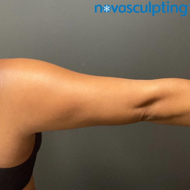 Arms