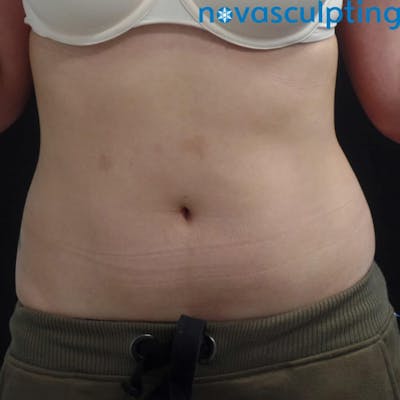 Abdomen Before & After Gallery - Patient 133024817 - Image 1