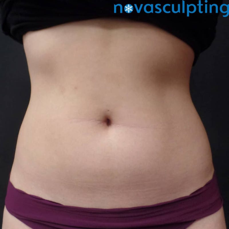 Abdomen Before & After Gallery - Patient 133024817 - Image 2