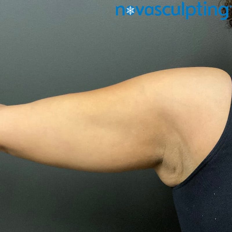 Arms Before & After Gallery - Patient 133024816 - Image 1